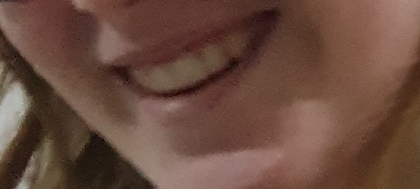 Eye tooth