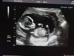 Nub theory? Is this a nub or babies leg?