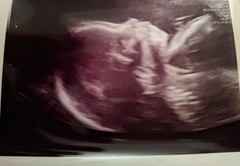 Pregnant After MMC - Thread 3