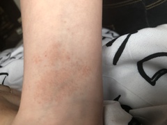 Can anyone help with the rash?