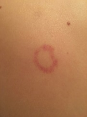 What is this rash please (pic)