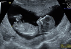 Boy or girl