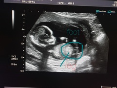 Nub theory? Is this a nub or babies leg?