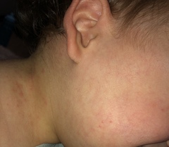 Rash ?