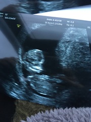 Pregnant After MMC - Thread 3