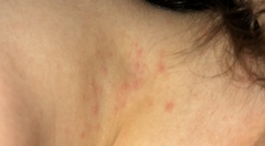 Rash ?