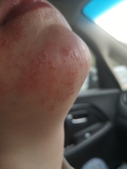 Does anyone know what this rash is?