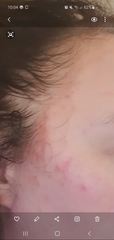 Desperately need help with my skin / Dermatitis