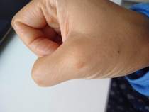 Is this Wart/Mole/Verruca ?