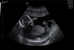 Pregnant After MMC - Thread 3