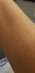 What is this spot/bite mark? pic included