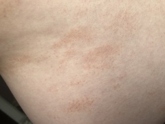 Can anyone help with the rash?