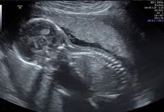 Pregnant After MMC - Thread 3