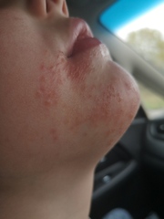 Does anyone know what this rash is?