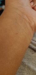 What is this spot/bite mark? pic included
