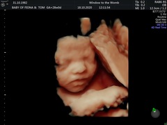 Catching up - TTC After Miscarriage part 3