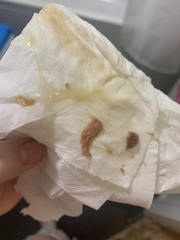 Anyone had this and been pregnant? **Content warning** Title edited by MNHQ