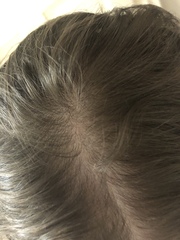 I think I might be losing my hair (Pics)