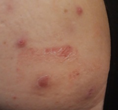 What is this boil/spot ....