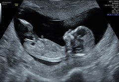 Boy or girl