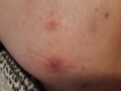 What is this boil/spot ....