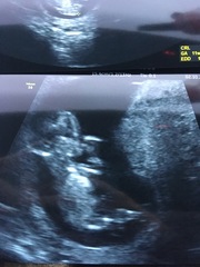 Pregnant After MMC - Thread 3