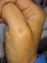 Is this Wart/Mole/Verruca ?
