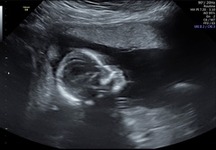Pregnant After MMC - Thread 3