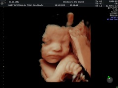 Catching up - TTC After Miscarriage part 3