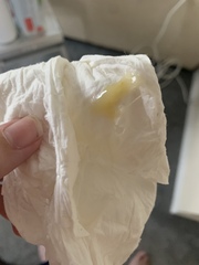 Miscarriage or implantation? [warning: contains photographs]