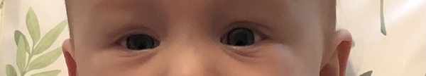 Baby with uneven size eyes