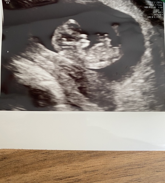 Pregnant After MMC - Thread 4
