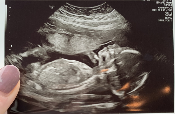 Pregnant After MMC - Thread 4