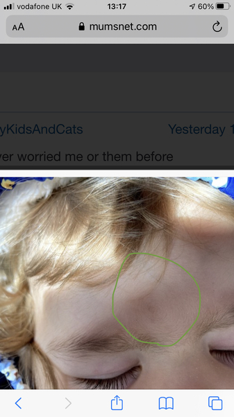 Toddler eyebrow/forehead abnormality?