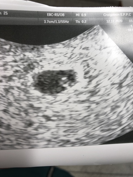 Early pregnancy
