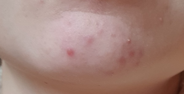 Does anyone else have pesky chin spots that just won't budge?! (Photo)
