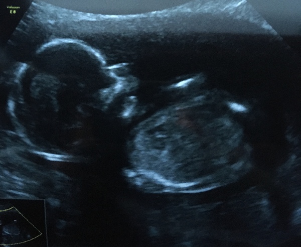 Pregnant After MMC - Thread 3