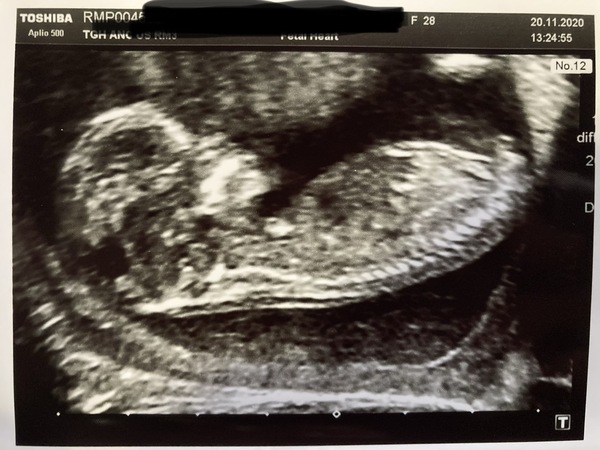 Boy or girl? 12 week scan