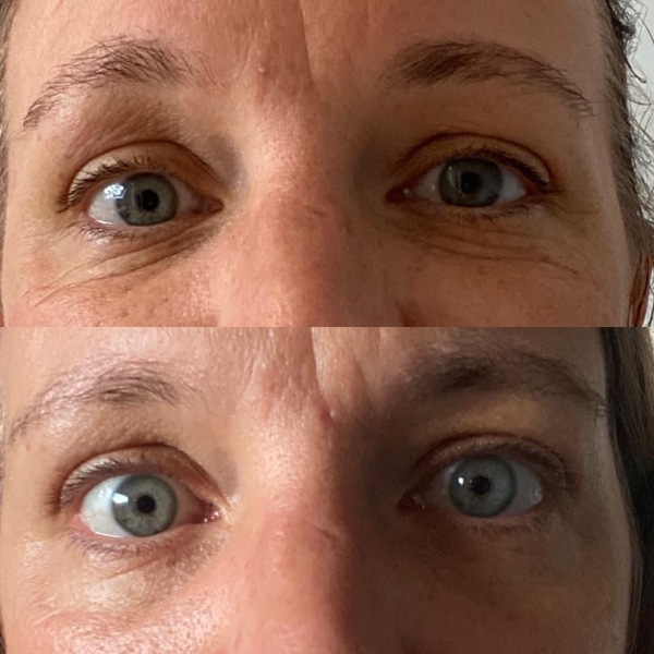 Anything for wrinkles directly under eyes?