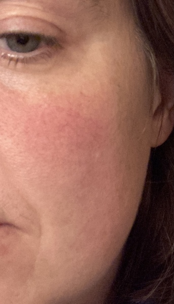 Skin care routine for rosacea