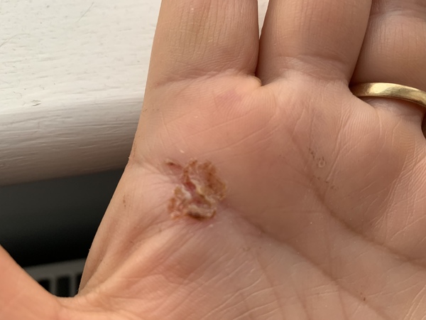 What is going on with this cut <warning - disgusting photo>