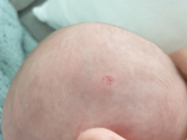 Ring of dots on babys head
