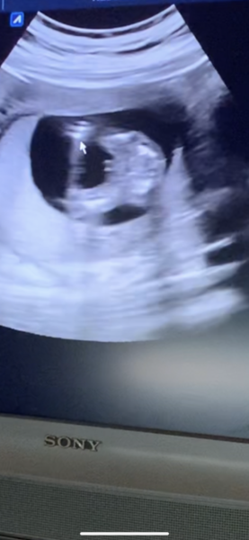 Boy on 14 week ultrasound?