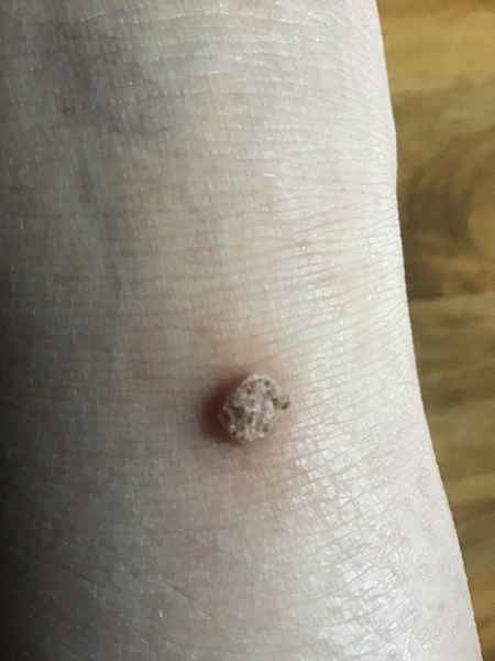 Wart or what pic included