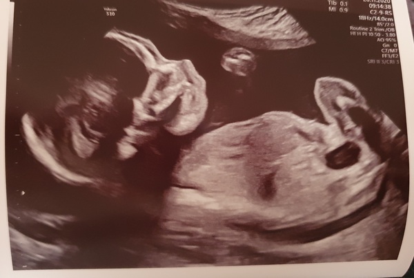 Pregnant After MMC - Thread 4