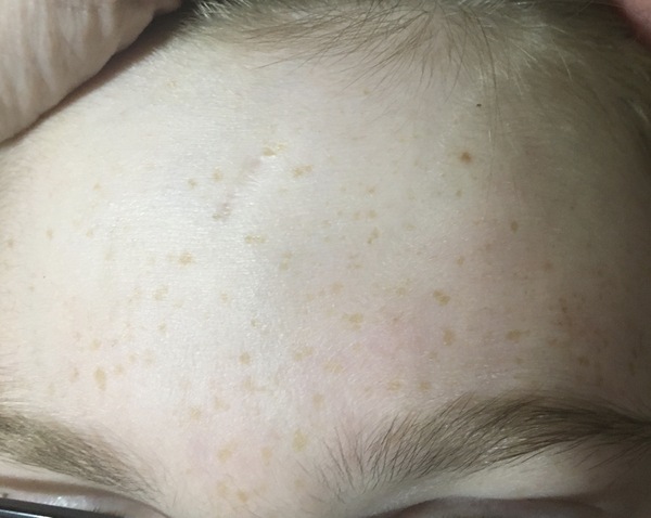 scar on daughter's forehead...should have been stitched and not glued!