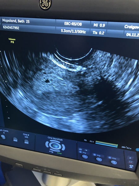 Early pregnancy