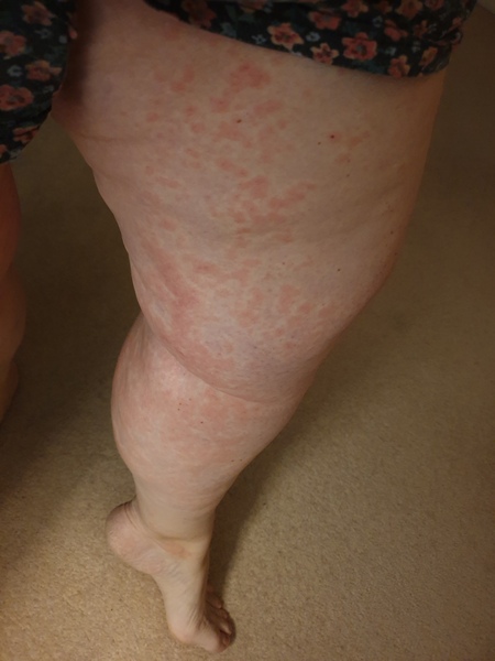 What sort of a rash have you seen in connection with covid?
