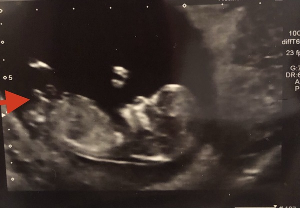 I'm thinking it's a girl. What do you think?