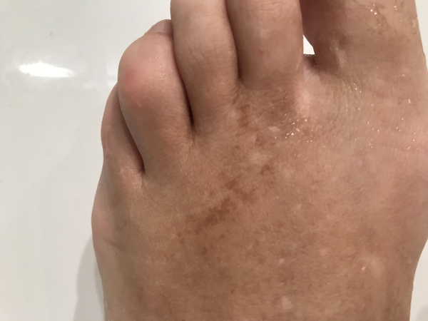 What might these skin patches be?